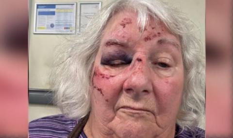 Christine Reid's face framed with grey hair, showing injuries from falling over on the uneven pavements. She has cuts to her forehead, nose and cheek with a bruise over her right eye.