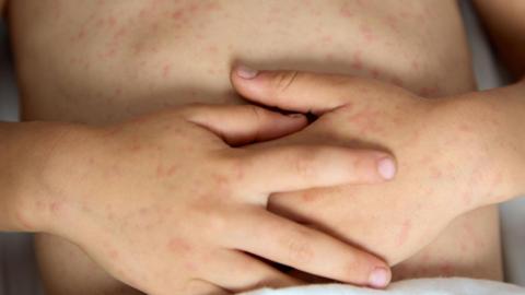 Child's hands on stomach - rash visible 