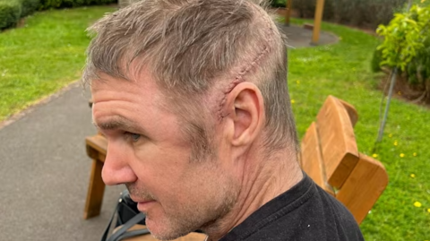 A close up of Scott's left side of his head where a six inch scar can be seen running from the side of his ear round to the back. The area is shaved. Scott is sitting on a bench in a garden with a lawn behind him.