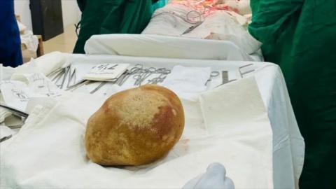 A massive bladder stone lies on a hospital operating table. It looks not unlike a potato.