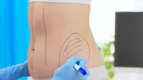 A clinician wearing blue gloves draws surgical markings on a woman’s abdomen and waist in preparation for a cosmetic procedure, with blue privacy screens in the background.