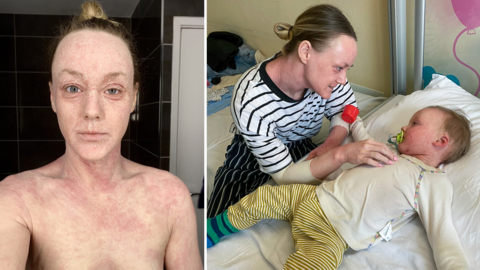 Bethany Norman portrait showing severe eczema and sitting by the hospital bed of her son with her arms are wrapped in bandages