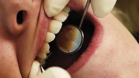 Close-up of a woman's open mouth, as a dentist examines her teeth with metallic tools