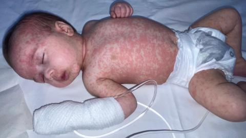 Baby with measles