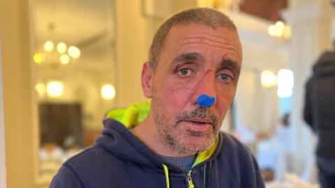 Aaron Ferbrache, He is wearing a blue hooded jumper.. He has injuries to his face and tape on his nose injuries. 