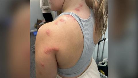Several red bumps on the back of a women's shoulder and arm.