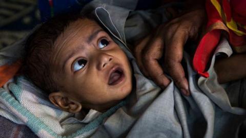 A malnourished child awaits treatment at a clinic in the Fakir Bagan slum area of Kolkata. The child is wrapped in blankets and is being held by an unseen person. The baby is looking up with an open mouth at the person and looks unhappy.