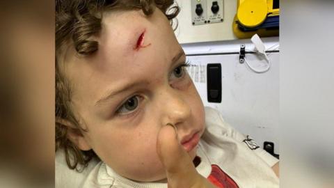 Finley Richard stares forward while in hospital with his headwound shown on his foreheard. The bloodied gash is in the centre of his forehead and is about the size of a 50 pence coin. His father's thumb is also seen as a point of reference for the size of the wound. 