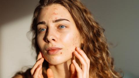 A woman with acne on her face