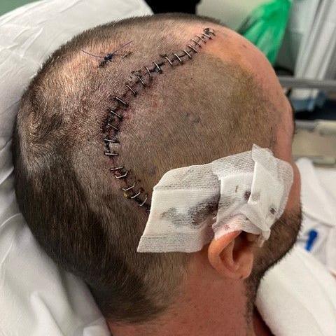 The side of a man's head, which has been shaved There is a large scar that is still healing running along the side of his head, it has lots of staples in it. Above the man's ear there are dressings attached