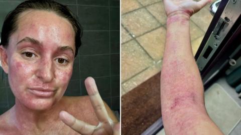 Split image between steroid withdrawal symptoms on woman's face and arm.