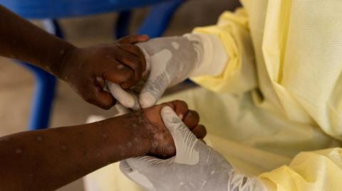 Christian Musema, a laboratory nurse, takes a sample from a child declared a suspected case of mpox at the treatment centre in Munigi, following mpox cases in Nyiragongo territory near Goma, North Kivu province, Democratic Republic of the Congo, 19 July 2024