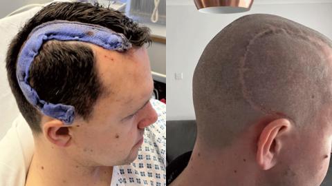 Two profile shots of Charlie post-operation. One shows blue bandaging covering his scar as he sits in his hospital bed, the second shows his head completely shaved, the healing scar a C-shape from the front of his head to the top of his ear.