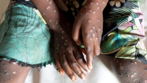 A child with mpox in Tshopo, DR Congo - archive shot