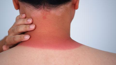 Close up of the back of a very red-looking, sunburnt neck.