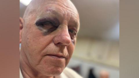 A close-up photo showing James Bentley. Bentley is clean-shaven with a bald head; he has deep purple and black bruising around his eyes. He is looking into the camera with a serious expression.