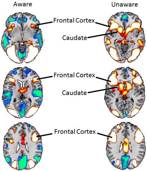 Brain activity of spider phobic people during repeated presentation of pictures of spiders - when they were aware of them (left column) and when they weren't (right column).