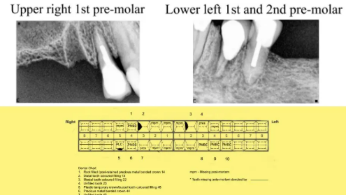 Mae'r heddlu'n gobeithio y gallai dannedd y dyn helpu i'w adnabod