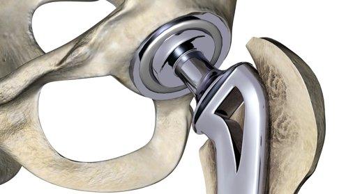 Hip replacement