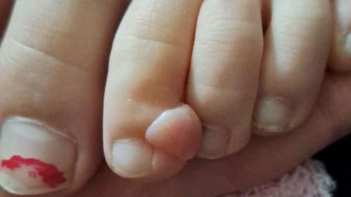 Nansi Alys' foot. On her second toe is a lump which was initially diagnosed as a wart