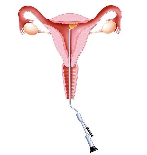 Drawing of a hysteroscopy