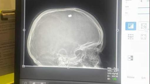 An x-ray image of a head injury