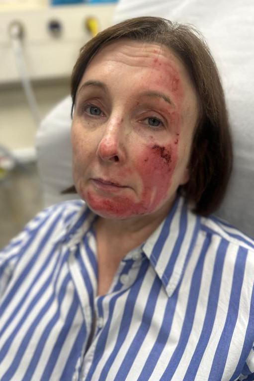 Woman with facial burns lying on hospital bed