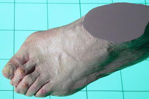 Model of a bunioned foot