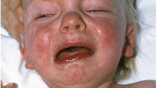 Child with measles