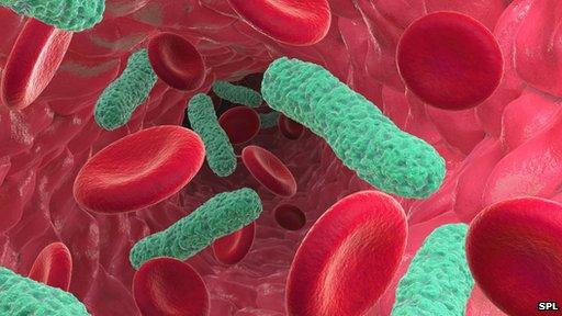 Bacterial infection of the blood causing sepsis