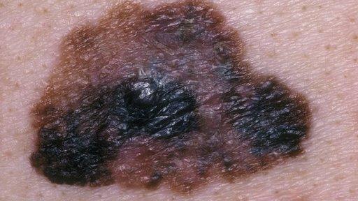 Melanoma or serious skin cancer