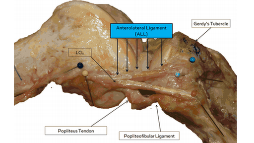 Anterolateral ligament of knee