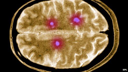 MRI brain scan showing multiple sclerosis lesions