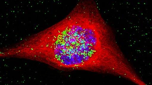 A cancer cell containing very small particles of gold (coloured green)