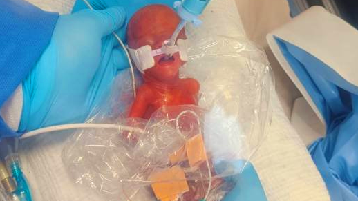 Baby Robyn in hospital with a tube in her mouth and a medic's hand holding her head, and with plastic around her