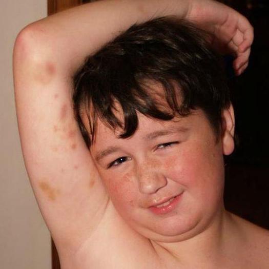 Calum Morrison, at the age of 11, lifting his arm up showing bruises