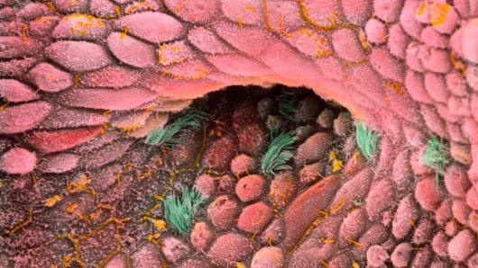 ovarian cancer