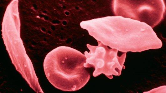 Red blood cell abnormalities caused by sickle cell disease