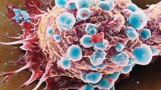 Breast cancer cell
