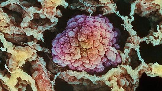 Lung cancer