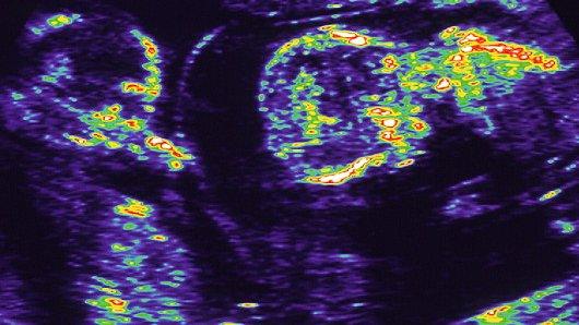 Twins in the womb