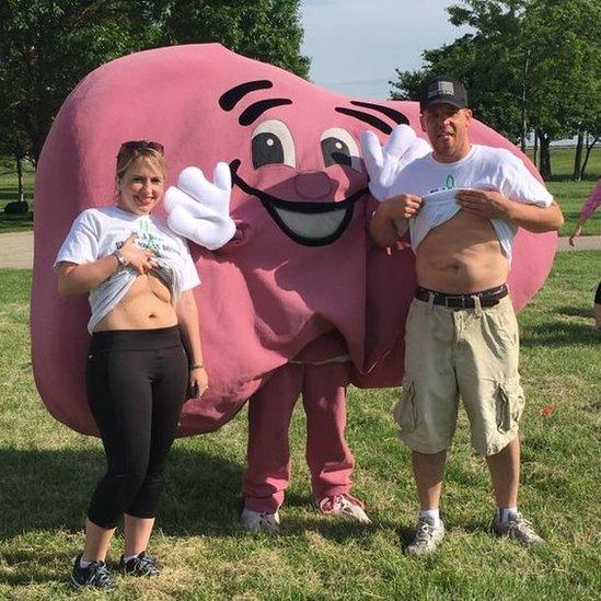 Heather and Christopher Dempsey show their scars in front of a pretend liver