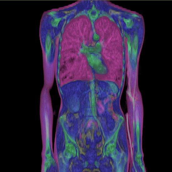 Entire Body, Frontal View. 3D Ct Scan.