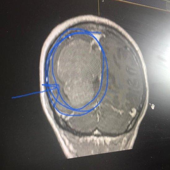 Brain scan showing tumour