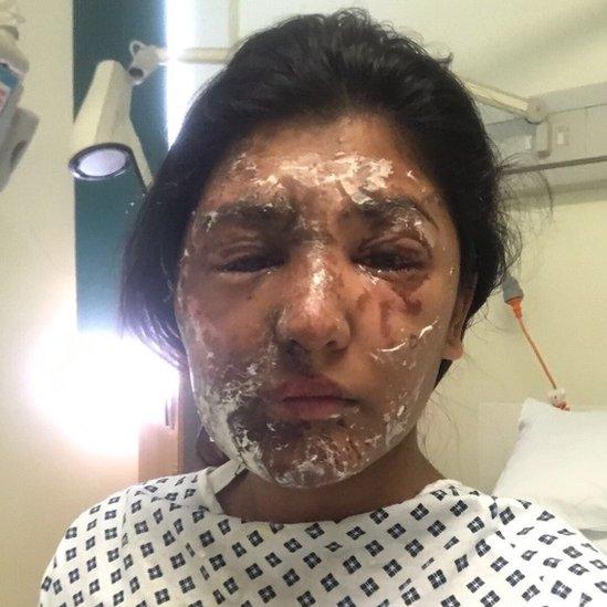 Resham Khan with facial burns