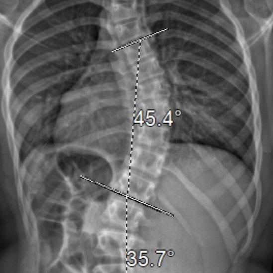 X-ray of skeleton