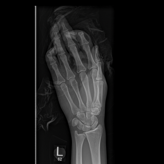 X-ray image of left hand