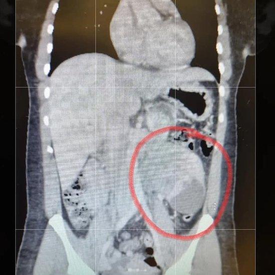 Scan of Stephanie Coles's tumour