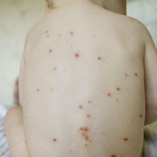 Chickenpox on an infant