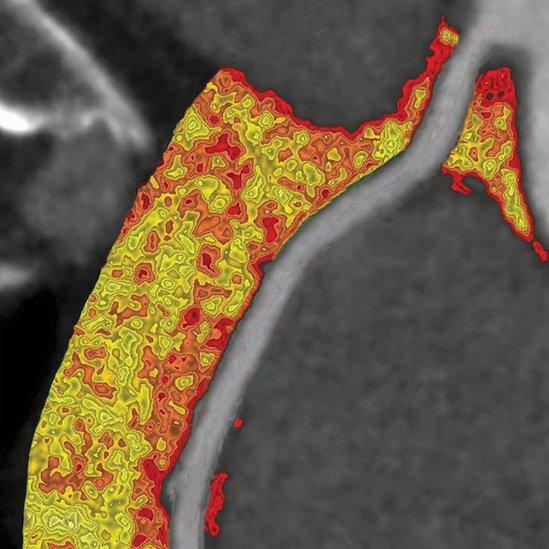 Scan showing inflammation of the arteries